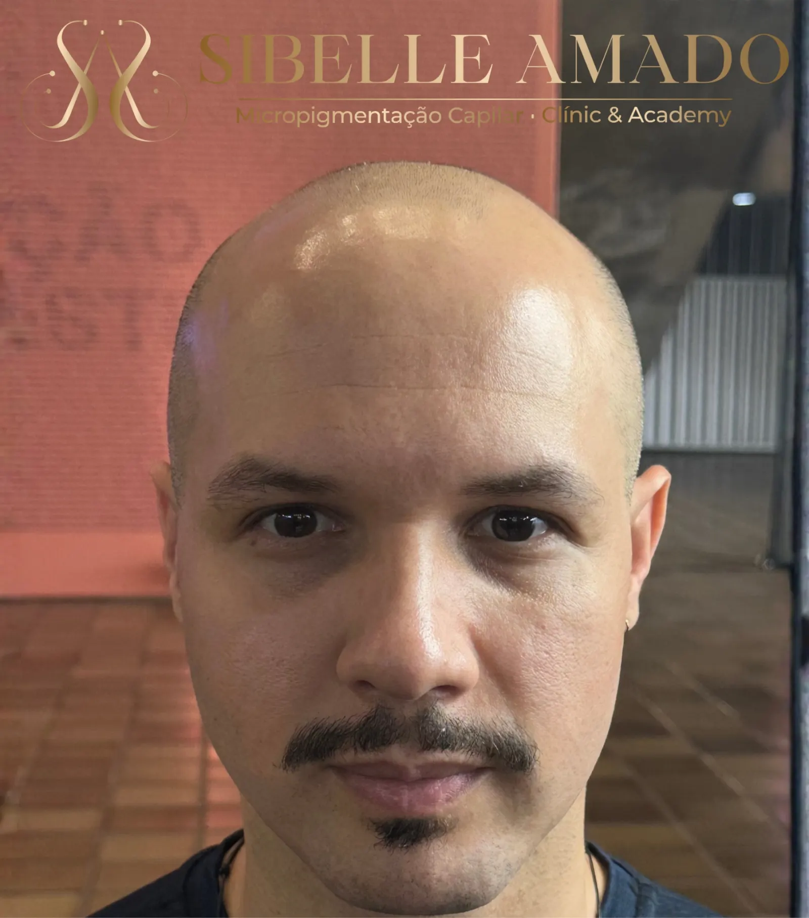 Antes da micropigmentação capilar masculina na região frontal realizada por Sibelle Amado