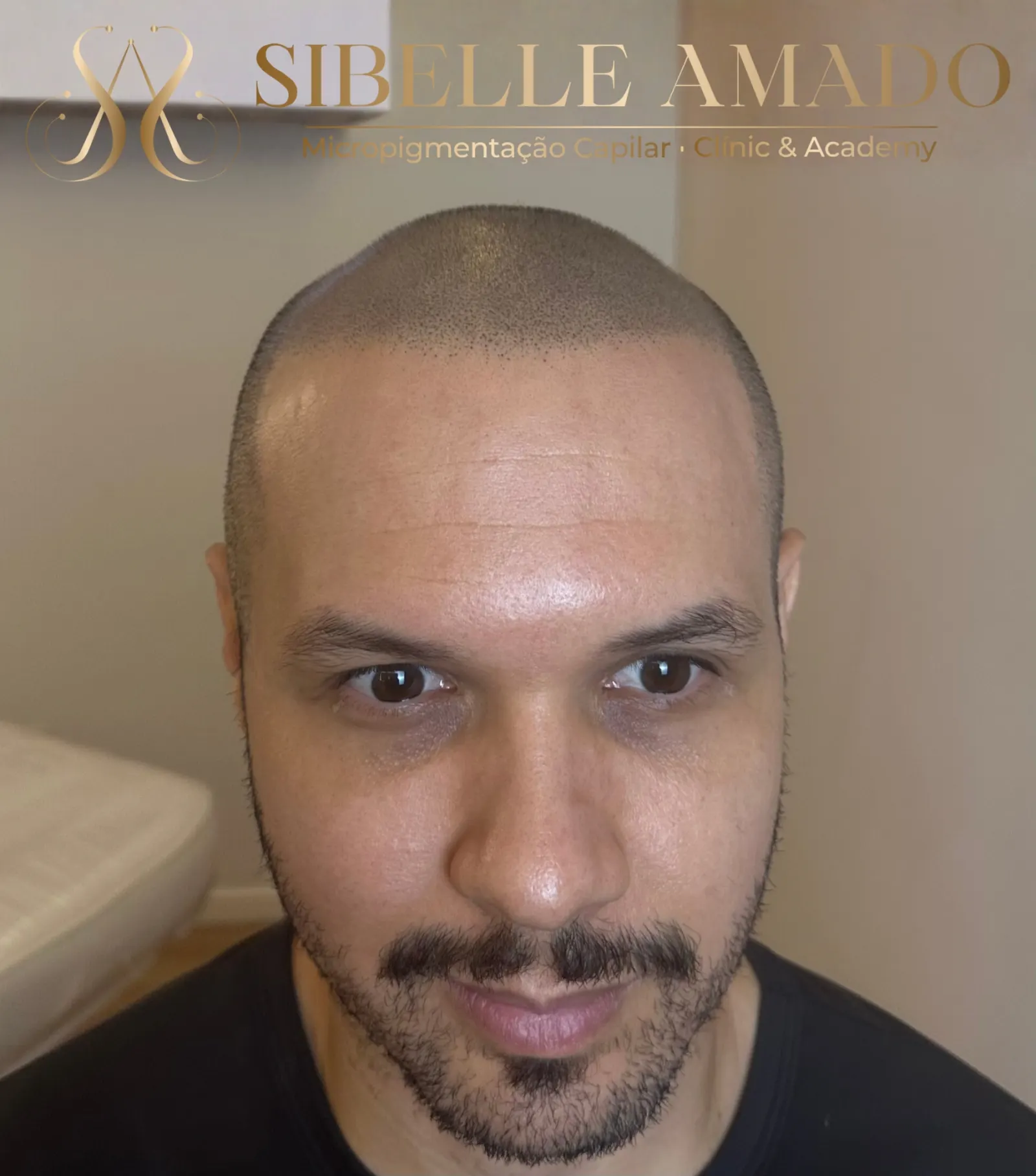 Depois da micropigmentação capilar masculina na região frontal realizada por Sibelle Amado