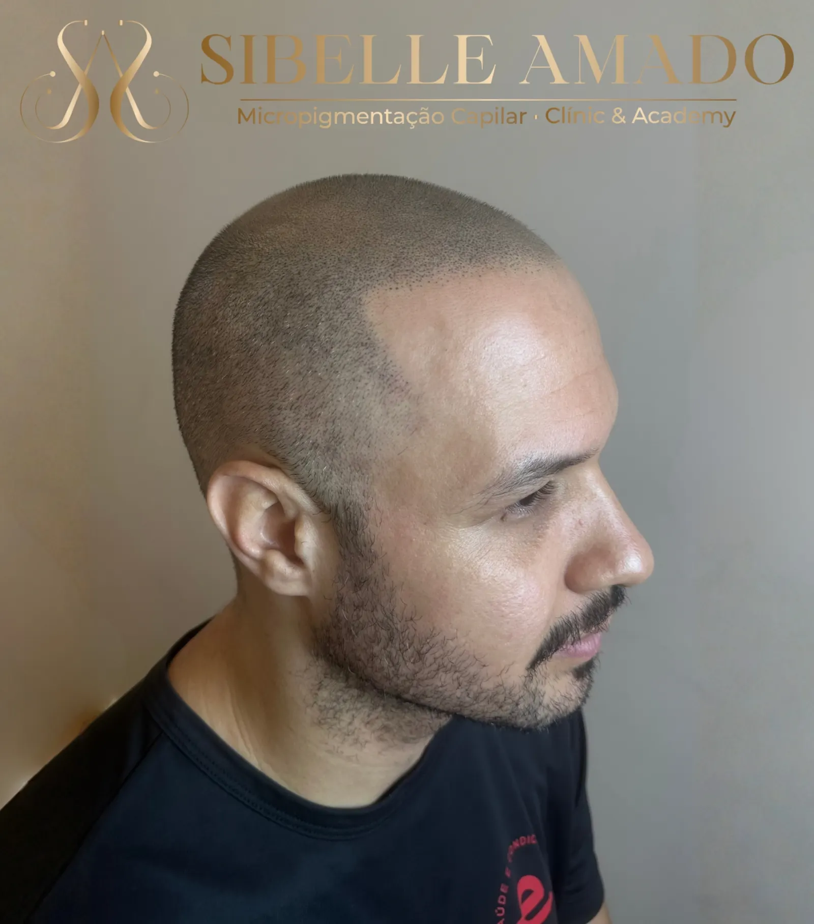 Depois da micropigmentação capilar masculina na região lateral realizada por Sibelle Amado
